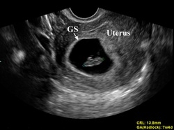 scan before 6 weeks